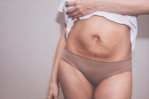 After a Cesarean Section, this Beautiful Scent Can Help