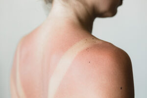 All-Natural Sunburn Treatments