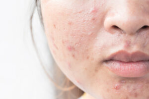 Clearing the Path: Probiotics for Acne Management