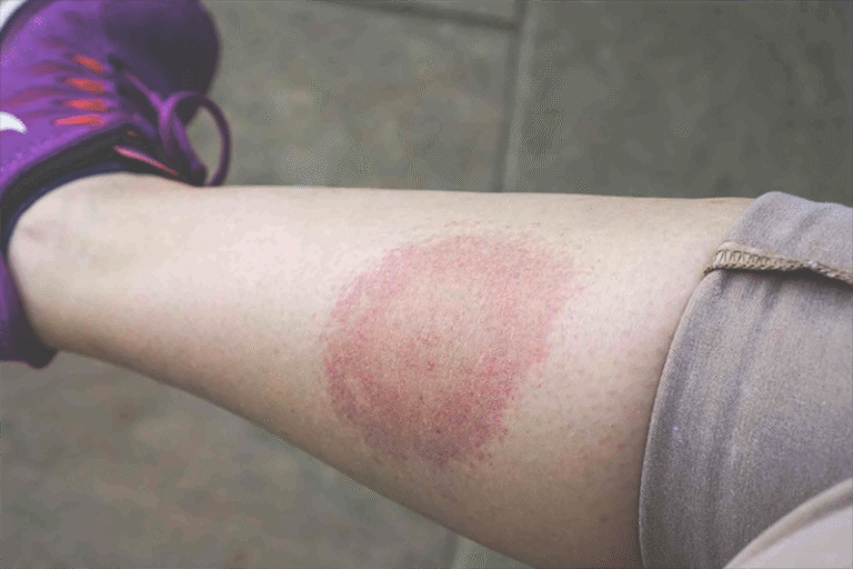 Early Signs of Lyme Disease